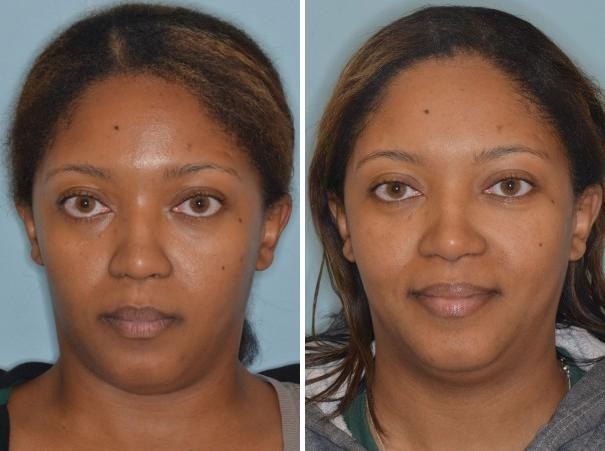 ethnic rhinoplasty cost nyc